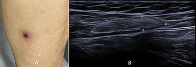 Case Report: Optic neuritis as the initial presentation of Orientia tsutsugamushi infection detected by metagenomic next-generation sequencing